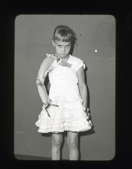 Mustavalkoisessa kuvassa pieni tyttö valkoisessa mekossa. Hänen oikean käsivartensa tilalla on tekokäsi, jonka päässä on metalliset pihdit. Hän on painanut leukansa alas ja katsoo hieman alta kulmien. 