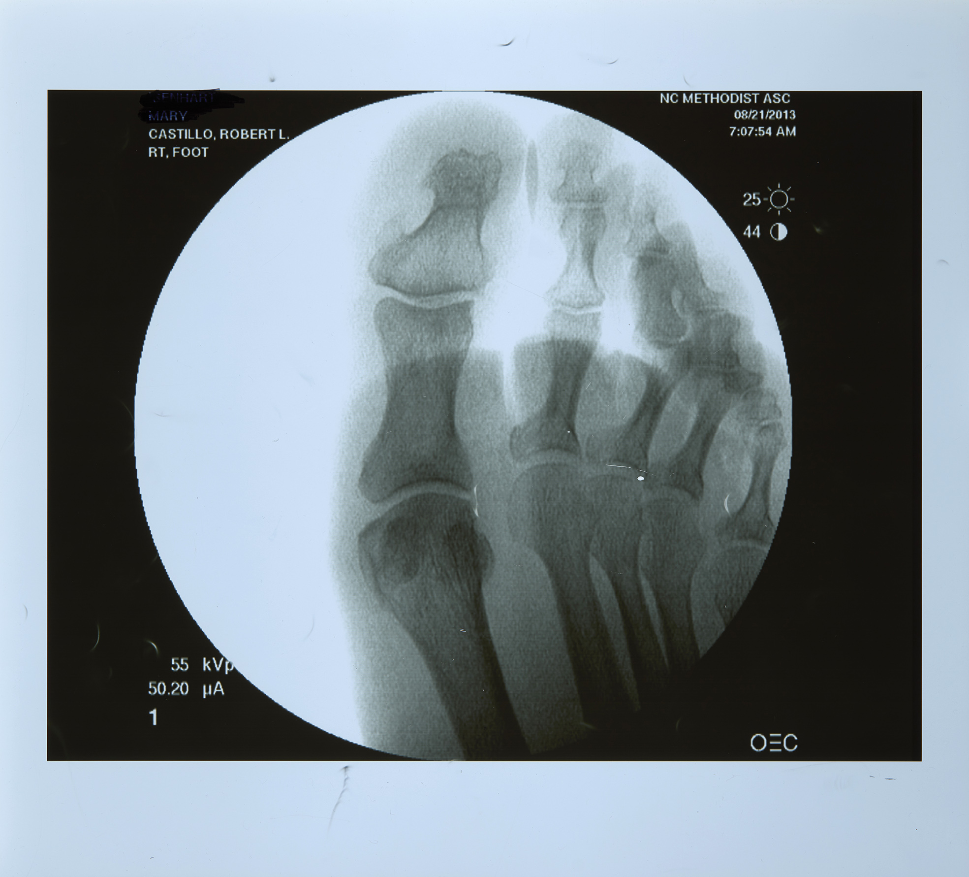 Röntgenkuva jalkaterästä.