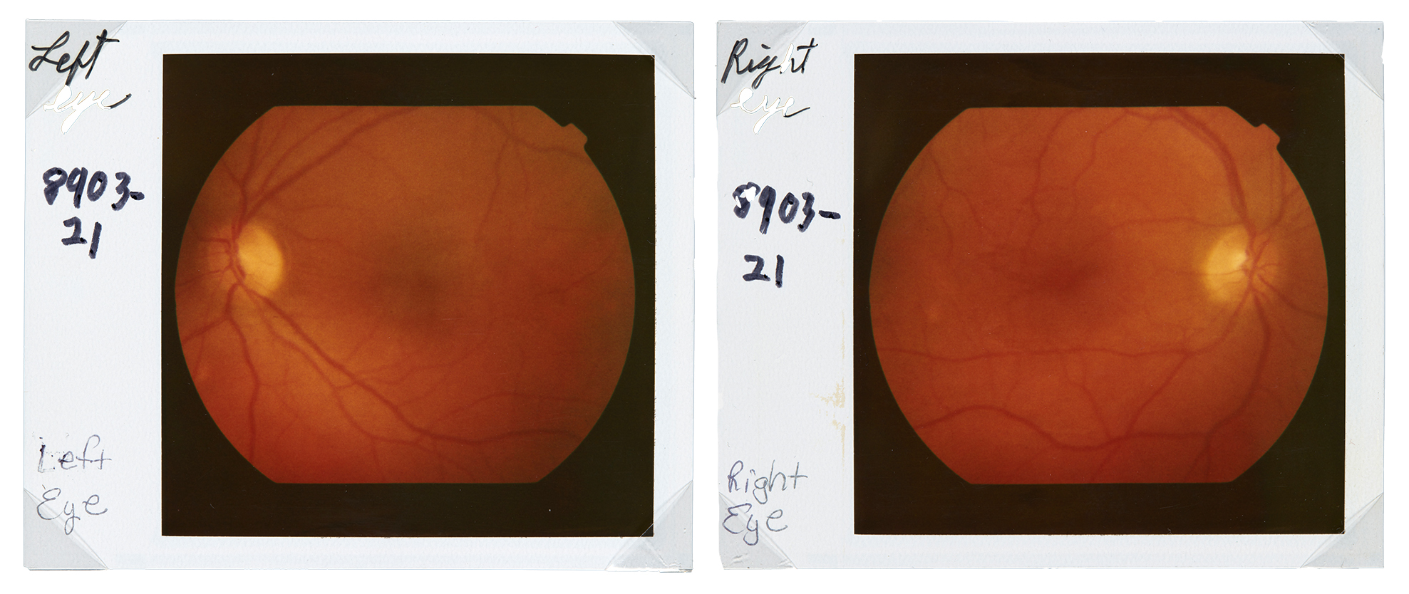 Kaksi polaroidkuvaa, jotka ovat värillisiä röntgenkuvia oikeasta ja vasemmasta silmästä.