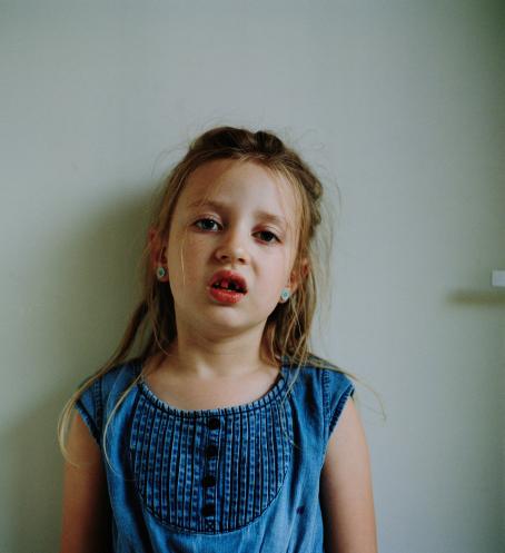 Tyttö sinisessä paidassa ja nappikorvakoruissa. Hänellä on suu vähän auki, yksi hammas puuttuu ylärivistä ja kolon ympärillä olevat hampaat ovat verisiä.  