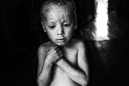 Mustavalkoisessa kuvassa pieni, paidaton lapsi, joka pitää käsiään rinnan päällä. Hänen ihonsa on kuiva ja siinä on pieniä tummempia kohtia ja viivoja. 